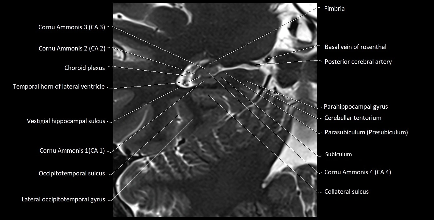 Hippocampus anatomy mri coronal cross section 3T MRI image 15.webp